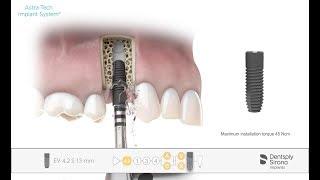 Implant installation Astra Tech Implant System EV