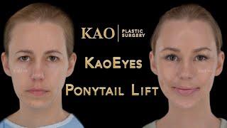 Picture Perfect Plastic Surgery | Scarless Facelift Before & After Video | Ponytail Lift | Dr Kao