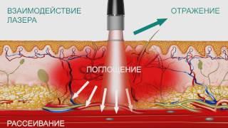 Лазер высокой интенсивности BTL-6000 HIL. Особенности технологии и медицинские эффекты.