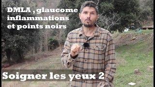 DMLA , glaucome, inflammations et points noirs - Soigner les yeux épisode 2 - regenere.org