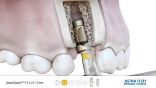 ASTRA TECH Implant System EV | OsseoSpeed EV Implantation