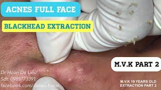 Nặn mụn nhọt mụn ẩn|Squeeze BLACKHEADS, whiteheads, hidden acnes, anti acnes 0985773391 part 2