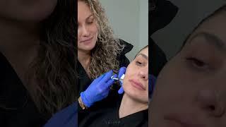 Jawline Contouring with JUVÉDERM VOLUX | Nurse Natalia