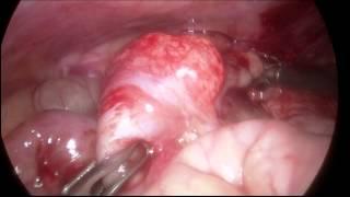 Laparoscopic reduction of Intussusception