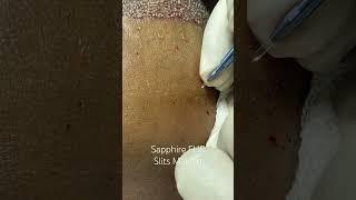 Sapphire FUE Slits Making at Cara Clinic Mumbai | Best Hair Transplant Technique