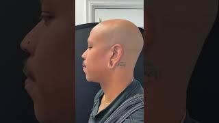 Repairing an ear lobe after gauges #earloberepair #gauges #stretchedears #viralshort #plasticsurgeon