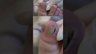 Bleeding of an ingrown nail can be made worse by doing this...