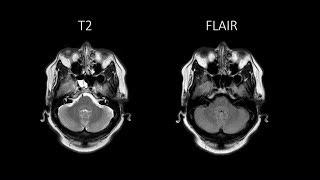 Utility of Intraoperative Fluorescein for CSF Leaks