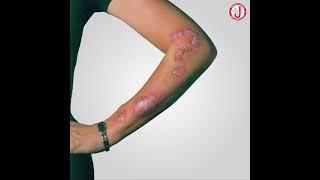 Psoriasis - Myths & Facts