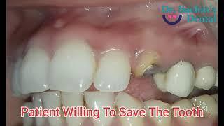 Patient Willing To Save The Tooth | Dr. Sachin's Multispecialist Dental Clinic