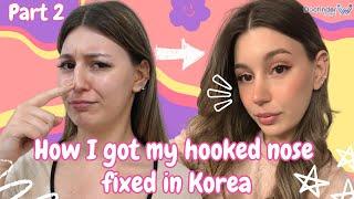 Who said Korean Rhinoplasty is only for Asians | Part 2 | Getting rid of nose hump, Deviated Septum