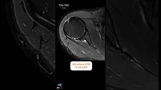MRI SHOULDER – KNOW YOUR TECHNIQUES WELL