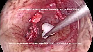 Placement of partial ossicular replacement prosthesis on stapes head.