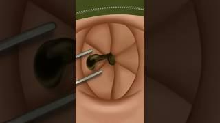 ASMR Satisfying navel stone removal #shorts #ytshorts #youtubeshorts #animation