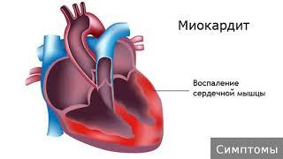 Миокардит. Как лечить миокардит.