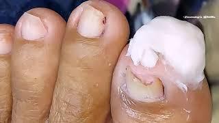 Pedicure update,after 2 weeks/antifungal treatment(Part2) | Beauty's Skills