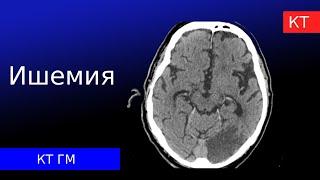 Ишемический инсульт на КТ и гипоксико-ишемическое повреждение головного мозга