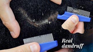 ASMR Real DANDRUFF  | Super Zoomed | Scratching, Parting Triggers For Sleep