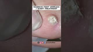 PATIENT MIGHT USING **BAZUKA** MASSIVE FOOT VERRUCA / WART TREATMENT BY PODIATRIST MISS FOOT FIXER