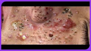 . Satisfying Blackheads Removal: Pimple Popping on Skin 2024