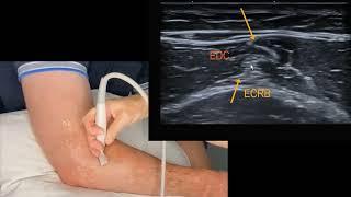 Elbow Sonoanatomy - Live Scan Introduction Lateral Structures (CET, RCL, LUCL)