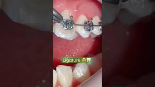 How Ligature Placed on the Bracket|Ligature Placed on Braces|Orthodontic Dentistry Treatments