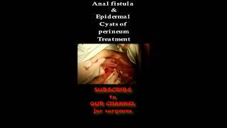 Anal fistula & Epidermal Cysts of perineum Treatment.