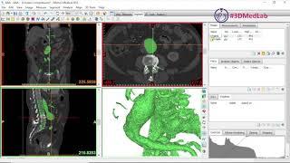 How to Segment a AAA for 3d Printing with Materialise Mimics