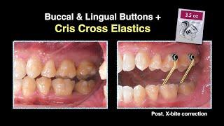 Crowding & Posterior cross bite Aligner｜【Chris Chang Ortho】CC811