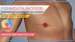 Transgender & Nonbinary Fishmouth Incision Top Surgery described by Dr. Scott Mosser