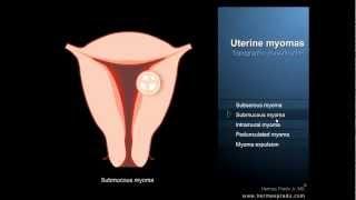 Uterine fibroids or myomas - Definition and symptoms