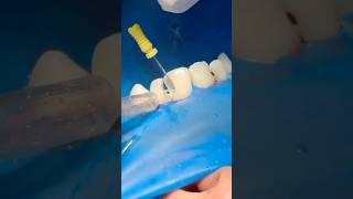 Tooth nerve #dentist