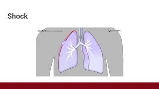 COVID-19 Ventilator Management - Part 2: Troubleshooting Common Ventilator Problems