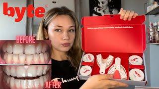 Byte Aligners Journey | How Much Did They Cost? Are They Worth It?