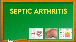 septic arthritis  risk factors, causes , sign and symptoms, diagnosis and treatment  @ImMEDICAL.