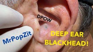 DPOW with firm blackhead lodged deep in ear. Keratin pocket expressed just behind ear pearl.Must see