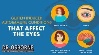 Gluten induced autoimmune diseases that affect the eyes