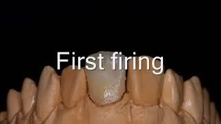 stratification de ceramique ( build up ivoclar emax )