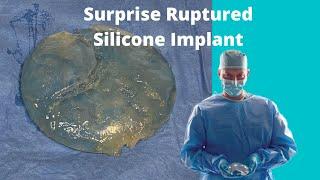 Silicone Breast Implant Rupture Discovered During Breast Augmentation Surgery