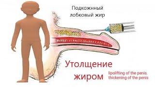 Липофилинг полового члена. lipolifting of the penis. thickening of the penis.