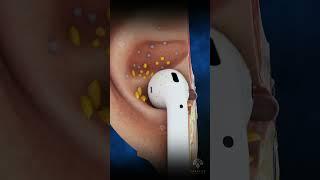 Why Your Earbuds Are Dirty #earinfection #earwax #shorts #viral -creativelearning3d