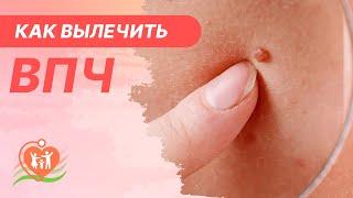 ​ Вирус папилломы человека. Как вылечить ВПЧ?