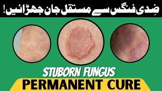 Fungus Treatment | Home Remedies for Fungus | Fungus ka gharelu Elaaj