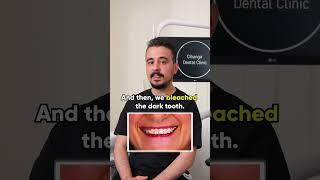 Story of A Challenging Smile Design with Dr. Halis