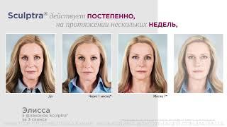 Sculptra - стимуляция выработки коллагена