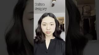 Before and after Facial contouring surgery and rhinoplasty (after one month only!)