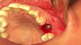 Immediate Implant Placement and Provisional Crown (Thai Vinh Nguyen, DDS)
