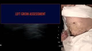 Groin Hernia Ultrasound Part 2