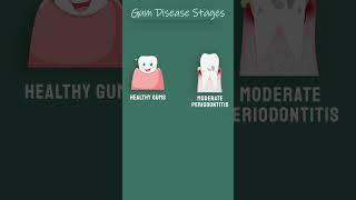 Helenzysdent | Gum Disease Stages | Dental Facts | Dental Tips |