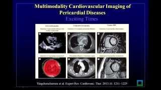 Multimodality Cardiovascular Imaging of Patients with Pericardial Disease